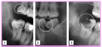 CBCT-bild som visar en retinerad visdomstand i underkäken i flera plan inklusive 3D-rekonstruktion.