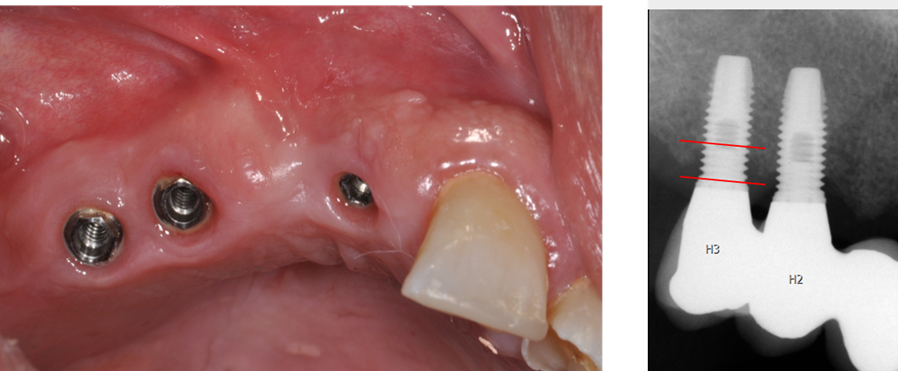 Klinisk bild och röntgen av dentalimplantat med mjukvävnad och benförlust markerad.