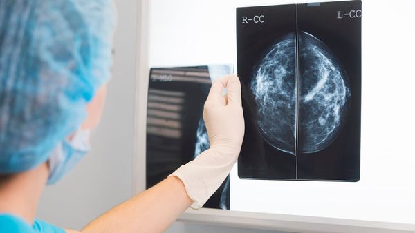 ECU study finds exercise could reduce breast cancer recurrence