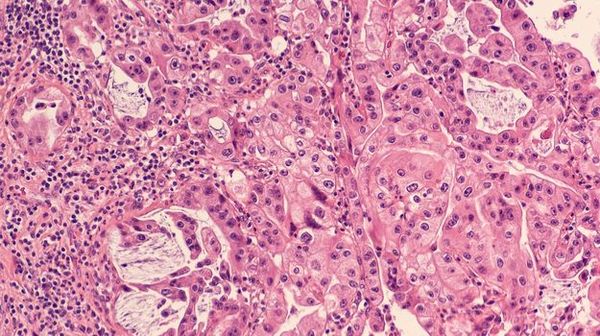 Of tumors and TMEs: new findings in pancreatic cancer spatial heterogeneity