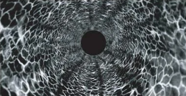 Peering beyond the surface with Gradient Index lenses