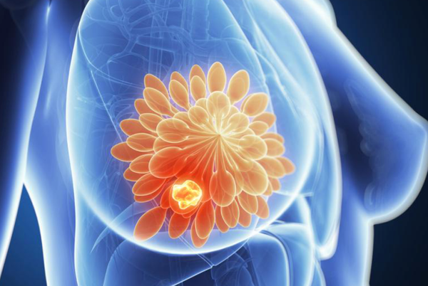 Freeze! Cryotherapy is the new weapon against breast cancer