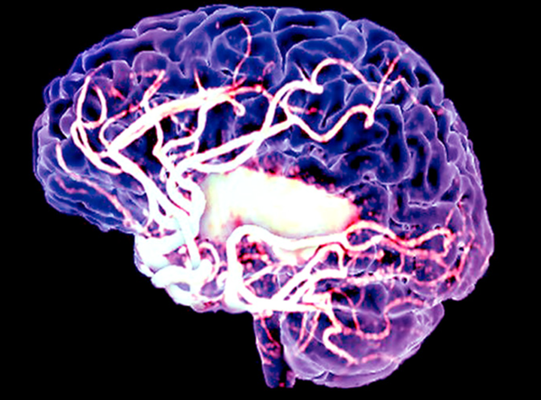 HIV drug is surprise helper in stroke recovery