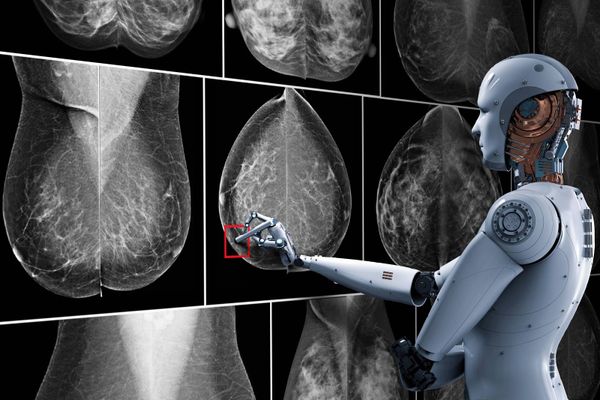 AI helps speed up breast cancer tracking but you can help too!