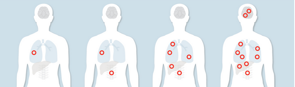 Cancer 101: Shapeshifting, invasion, and metastasis