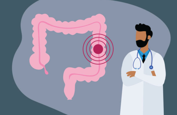 Are lifestyle factors increasing rates of early-onset colon cancer?