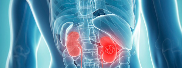 Combo Treatment Kicks Kidney Cancer to the Curb