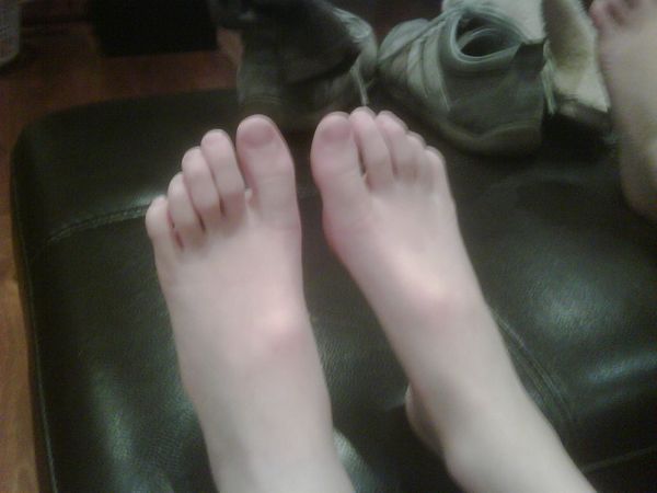 Jasper's tricky toes