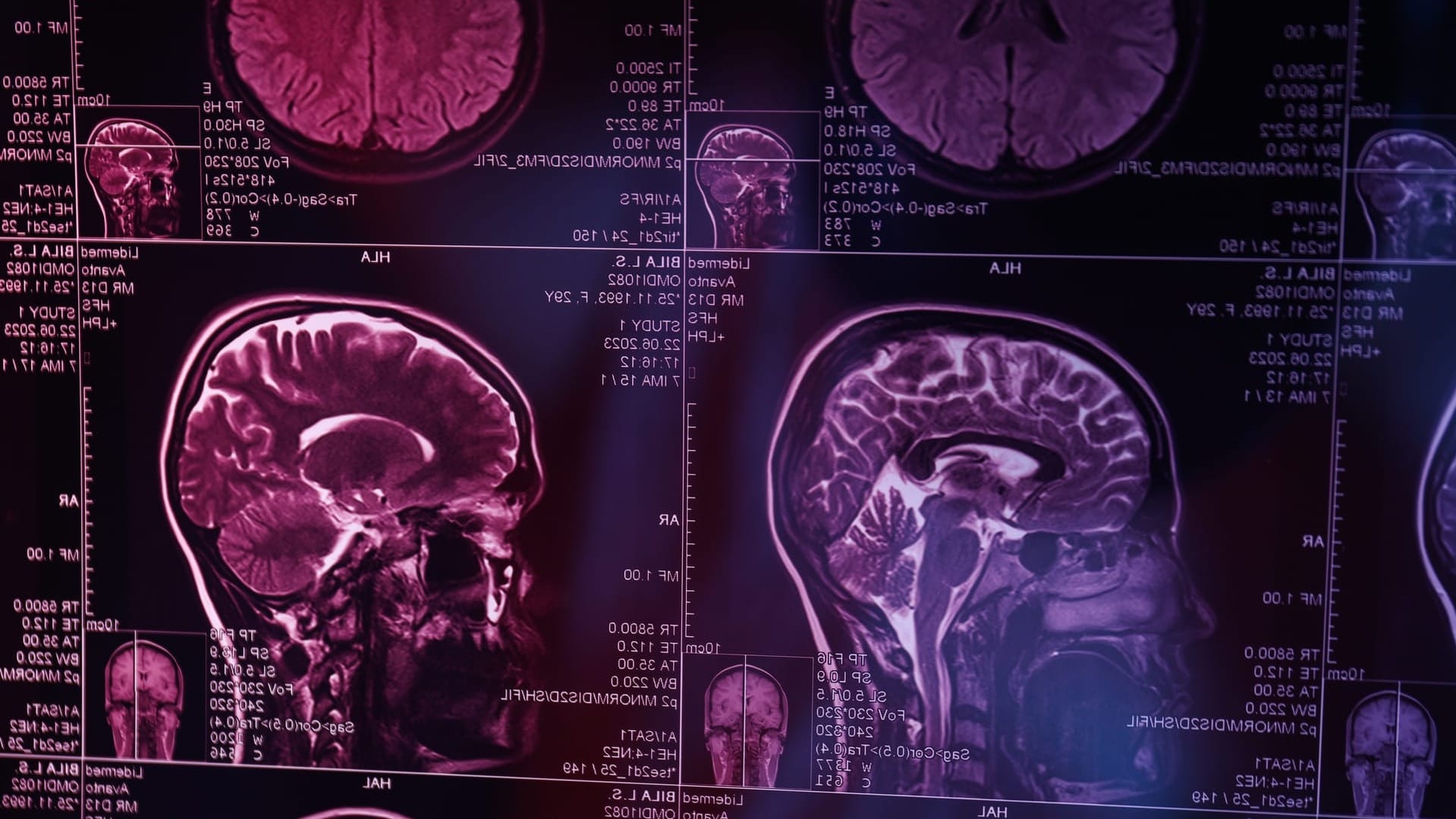 COVID-19 și îmbătrânirea cerebrală: Când timpul curge mai repede pentru creierul tău