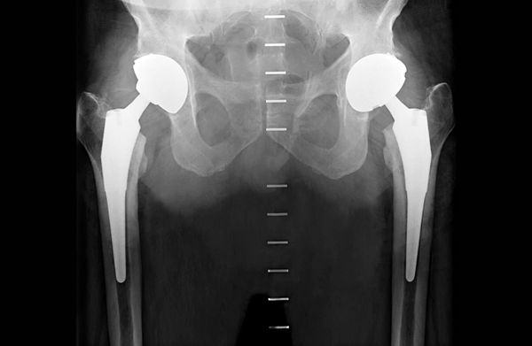 Hip Replacement Isn’t What It Used To Be 12 Weeks Ago