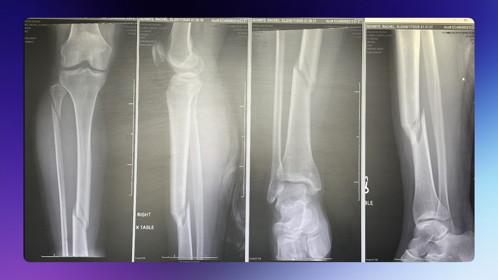 X-ray photos of the broken bones.
