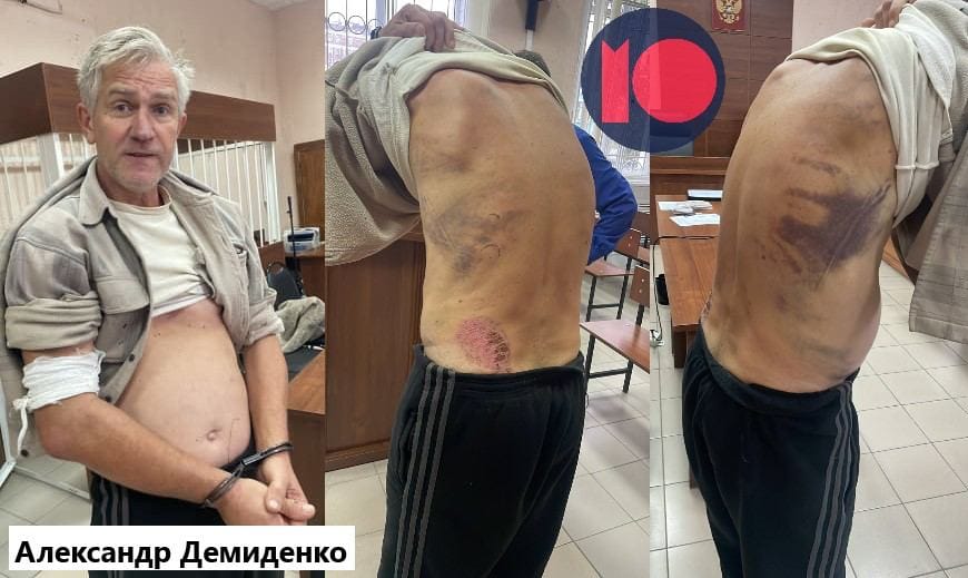 На волонтера завели дело о госизмене. Побои на теле волонтера Александра Демиденко