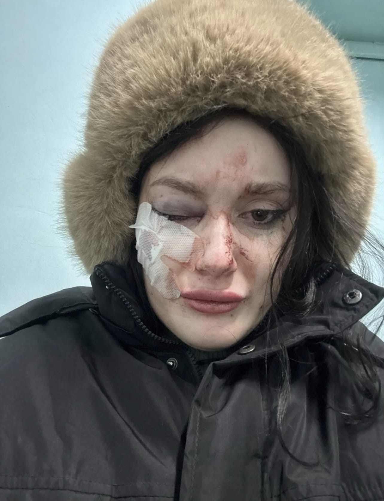У меня лопнул глаз от удара мужа