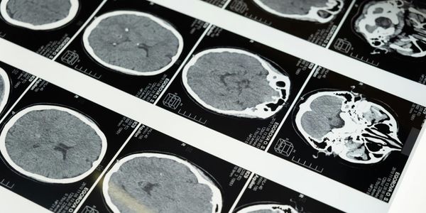 Фастфуд ухудшает работу мозга, а жить можно и без одного полушария?
