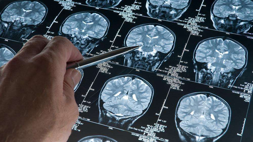 Brain messenger protein Arc identified as vehicle for Alzheimer's toxic spread, pointing to a new class of therapy