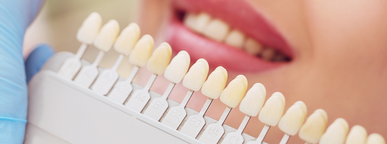 Lumineers Kosten  Wie teuer ist das neue Lcheln? | dentolo