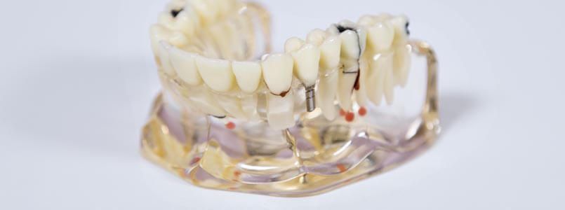 Zu sehen ist ein Zahnersatz-Schaumodell.