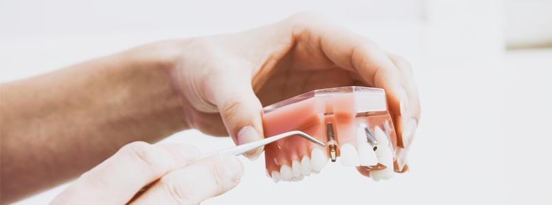 An einem Zahnmodell wird der Ablauf einer Implantation mit Zahnimplantaten dargestellt.