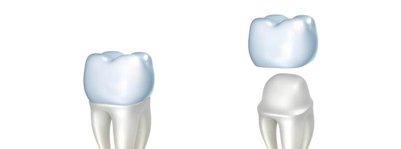 Zu sehen ist ein Modell einer Zahnkrone.