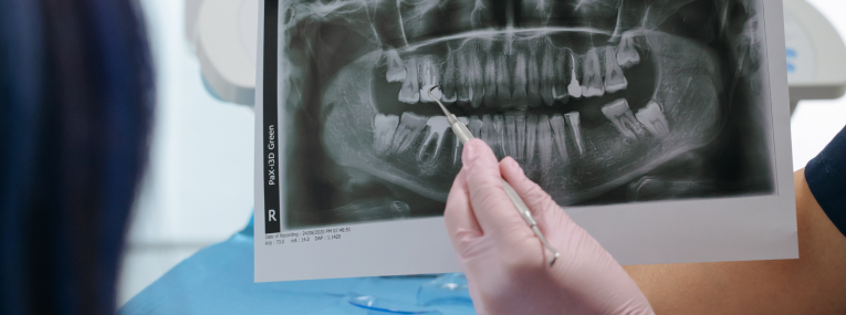 Ein Patient kann dank seiner Zahnversicherung eine Behandlung mit Implantaten beginnen.