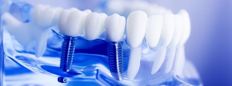 Zu sehen ist ein Schaumodell eines Kiefers, der nach dem All on 4 Behandlungskonzept mit Implantaten versorgt wurde.