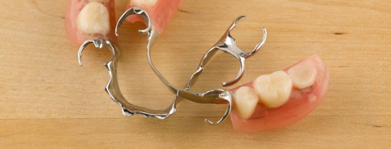 Zu sehen ist eine Klammerprothese als Zahnersatz.