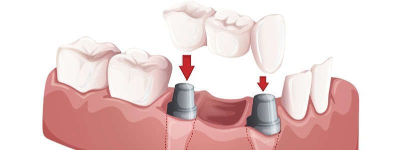Zu sehen ist eine Zahnbrücke, die im Unterkiefer eingesetzt wird.