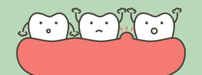 Zu sehen ist eine grafische Darstellung von Zahnfleischtaschen, die schnell zum Problem werden können.