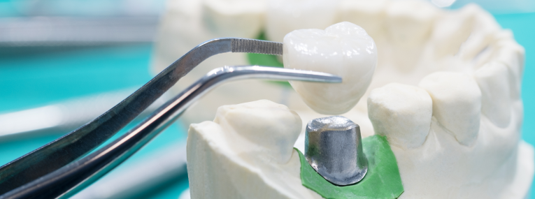 Zu sehen ist ein Schaumodell mit einem Implantat, um zu veranschaulichen, dass Zahnimplantate einige Risiken haben können.