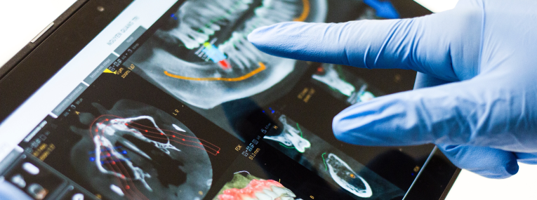 Zu sehen ist die virtuelle Planung von Implantaten bei der 3D Implantologie mithilfe eines Röntgenbildes.