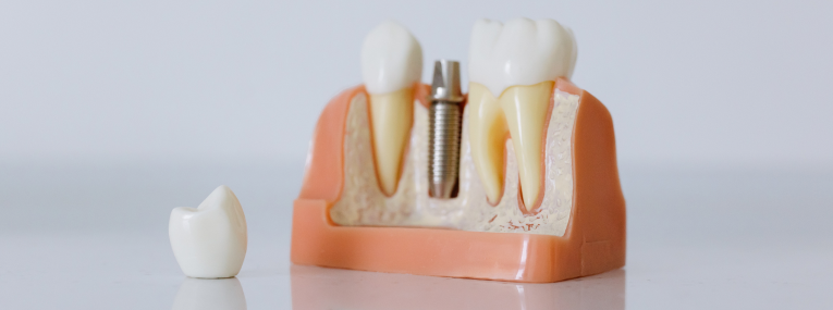 Zu sehen ist ein CAMLOG Implantat in einem Schaumodell eines Kieferknochens.