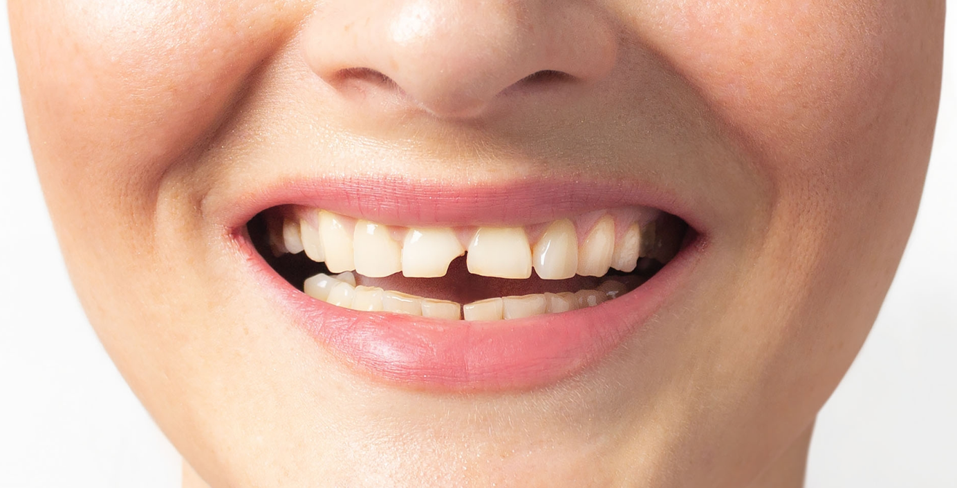 Eine Frau lächelt und zeigt dabei ihren abgebrochenen Vorderzahn.