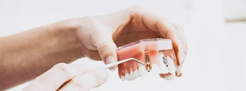An einem Zahnmodell wird der Ablauf einer Implantation mit Zahnimplantaten dargestellt.