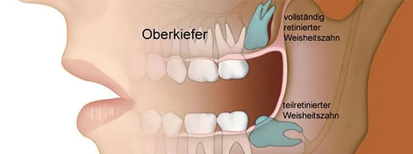 Zu sehen ist eine Grafik, die verschiedene Positionen der Weisheitszähne im Kiefer zeigt.