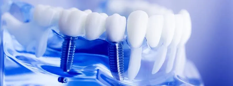 Zu sehen ist ein Schaumodell eines Kiefers, der nach dem All on 4 Behandlungskonzept mit Implantaten versorgt wurde.