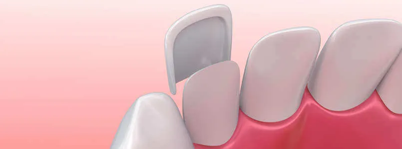 Zu sehen ist, wie Veneers an den Zähnen angebracht werden für ein strahlendes Lächeln.