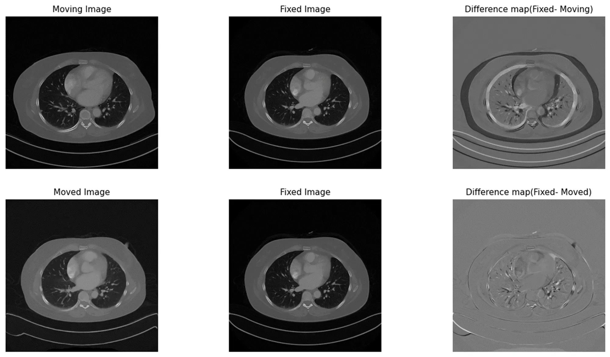 폐암 진단 및 추적을 위한 자동화 RECIST 기술 with Multi-Time Point Segmentation