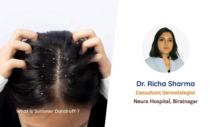 What is Summer Dandruff ?