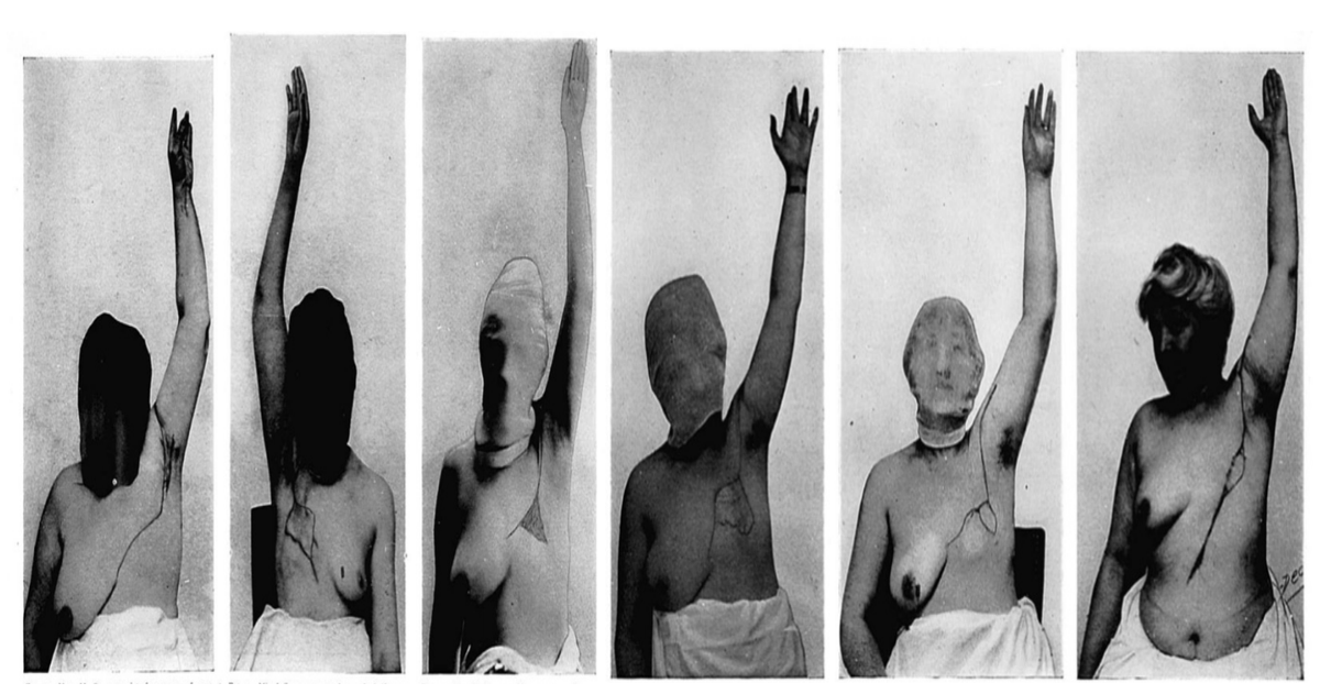 Statues of Liberty: Willy Meyer, William Halsted, and the Development of the Radical Mastectomy from 1880 to 1920