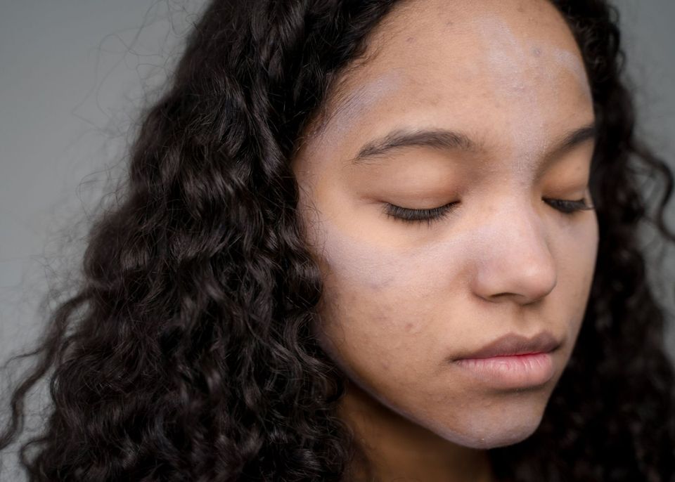 Acne on the Face