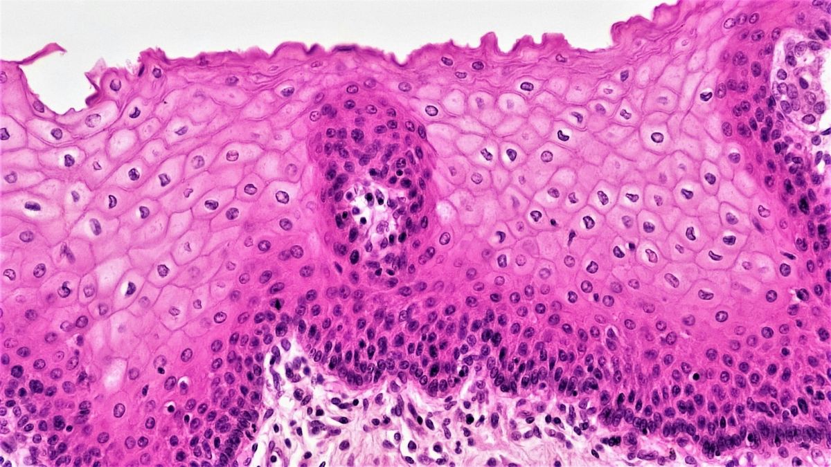 Moderna and Merck cancer vaccine succeeds in Phase 3 melanoma trial