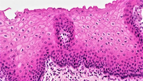 Moderna and Merck cancer vaccine succeeds in Phase 3 melanoma trial