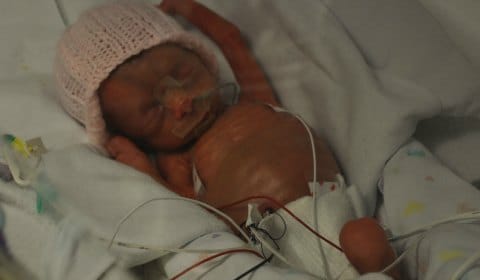 Natalie Walker during her stay in hospital after being born weighing just 1lb 9oz