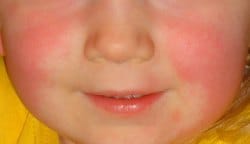A typical scarlet fever rash. Pic: Alicia Williams