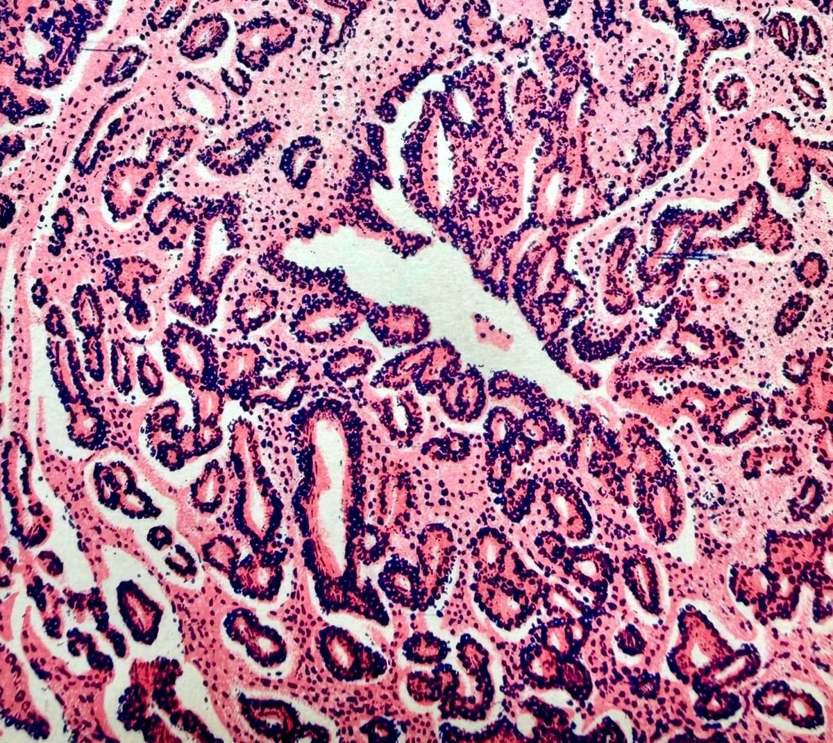 What "Curing" Cancer Could Mean In The Age Of AI