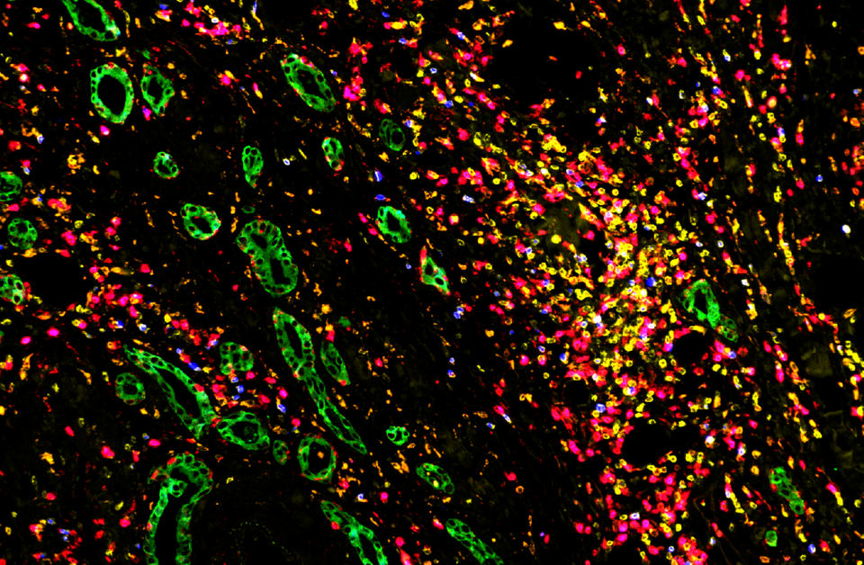 Elicio’s Therapeutic Vaccine For Pancreatic Cancer: A Revolution Hidden In Plain Sight?