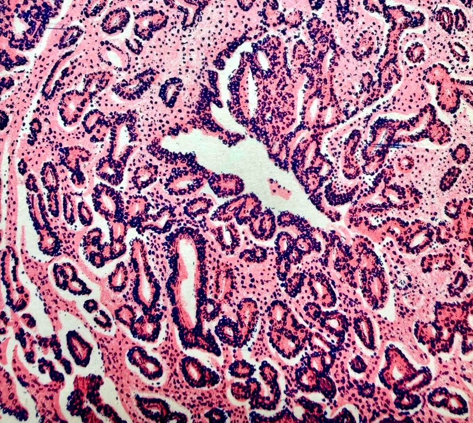 What "Curing" Cancer Could Mean In The Age Of AI