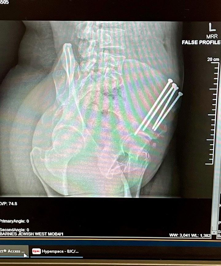 5 Key Facts About Acetabular Retroversion: What You Should Know