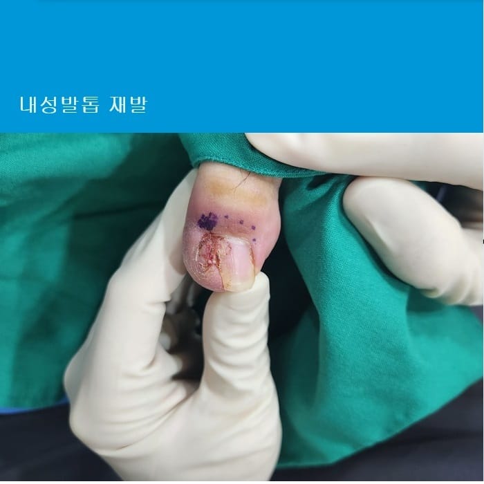 Ingrown Toenail Treatment & Surgery | Gangnam Standard Orthopedic Clinic Near Gangnam Station