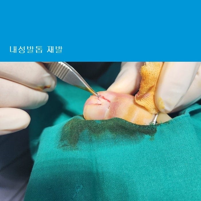 Ingrown Toenail Treatment & Surgery | Gangnam Standard Orthopedic Clinic Near Gangnam Station — 2